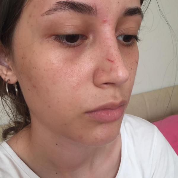 Yalova'da şort giydiği için saldırıya uğrayan kız konuştu #2