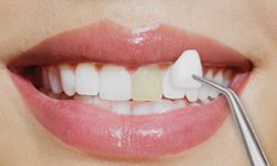 Diş Estetiği Nedir ve Doğru Klinik Nasıl Seçilir?