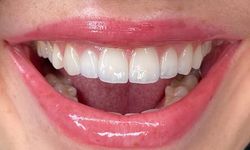 Hollywood Smile Uygulaması Nasıl Planlanır?