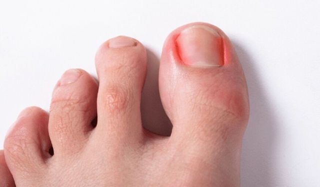 Tırnak Batması Neden Olur? Belirtileri Nelerdir?