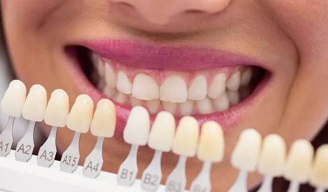 Emax Diş Kaplama Hangi Estetik Problemlerde Öne Çıkar?